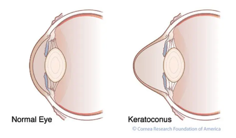 Eye Condition Focus: Keratoconus