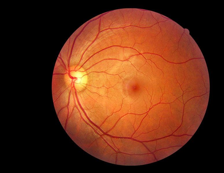 Epiretinal Membrane | LaserVision